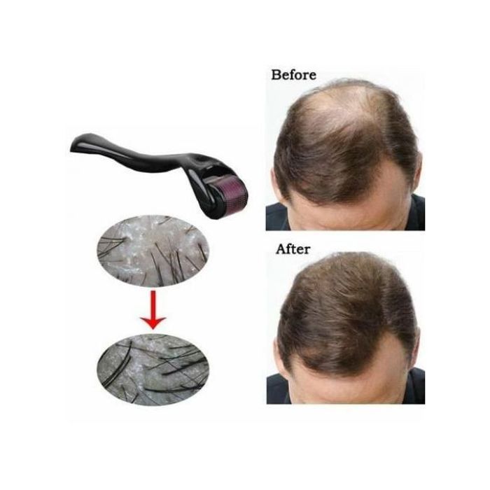 Derma Roller : Repousse des Cheveux & Croissance de la Barbe