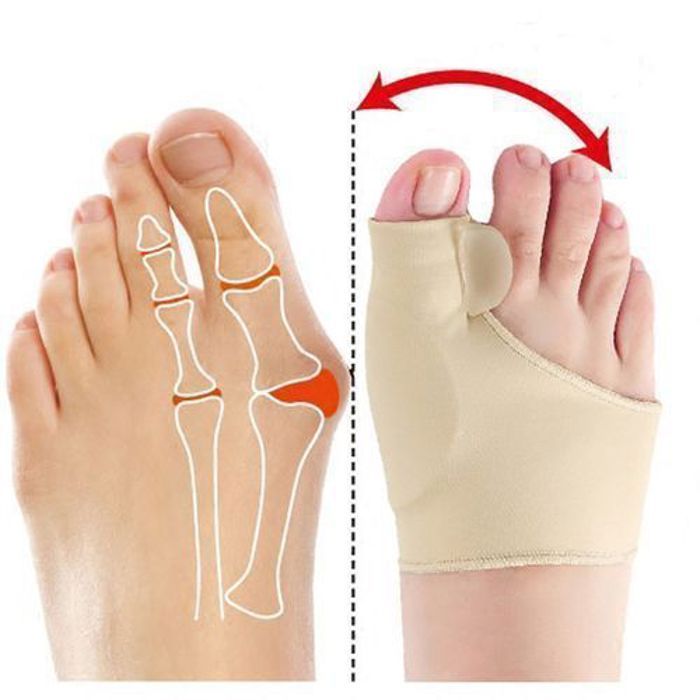 Correcteur d'orteils - Soins des pieds - Hallux Valgus - 2 pièces - Beige - Mixte