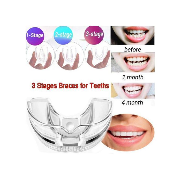 Correcteur de dents orthodontiques dentaires en 3 étapes, d'accolades invisibles